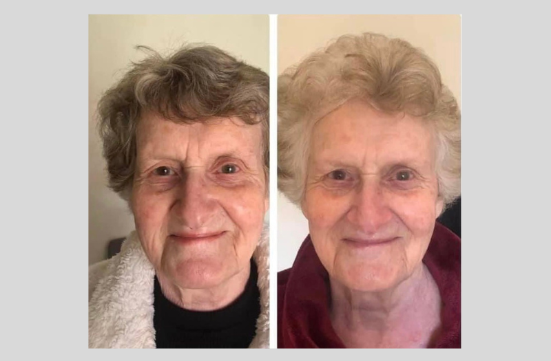 Before After Phototherapy