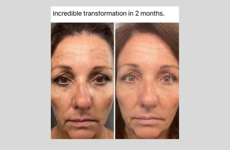 Before After Phototherapy