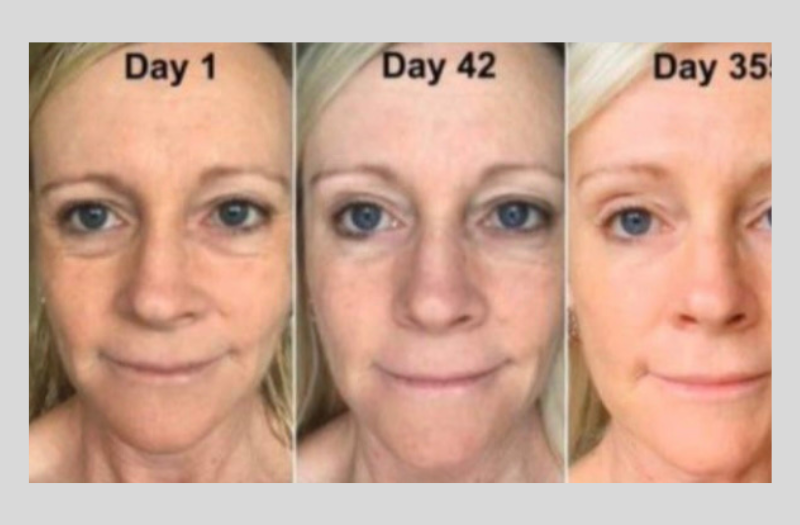 Before After Phototherapy