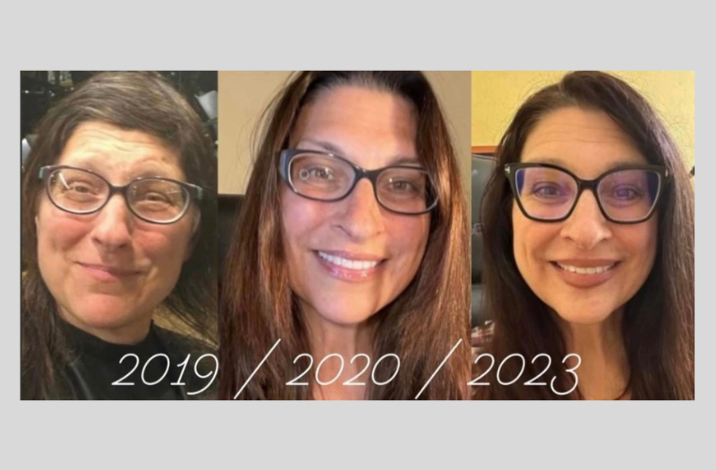 Before After Phototherapy