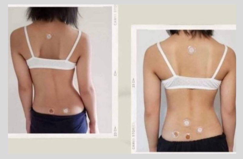 Before After Phototherapy