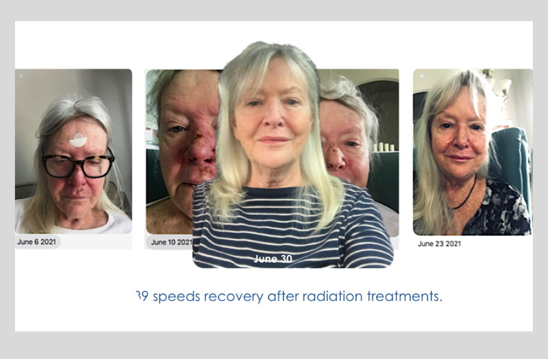 Before After Phototherapy