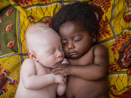 Blank ebbenhout – Albino’s in Afrika
