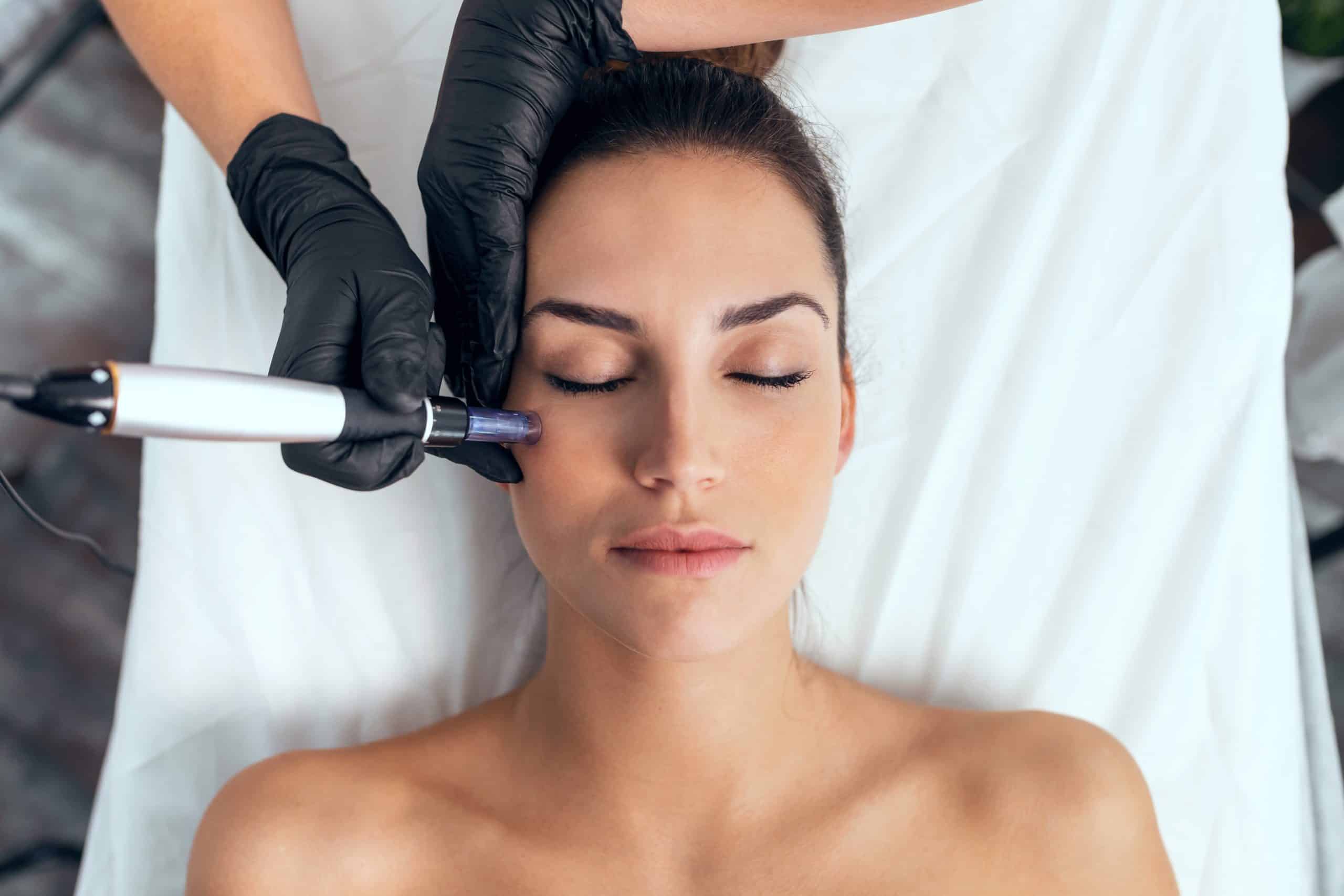 microneedling