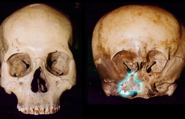 Un normale cranio e il teschio di Starchild
