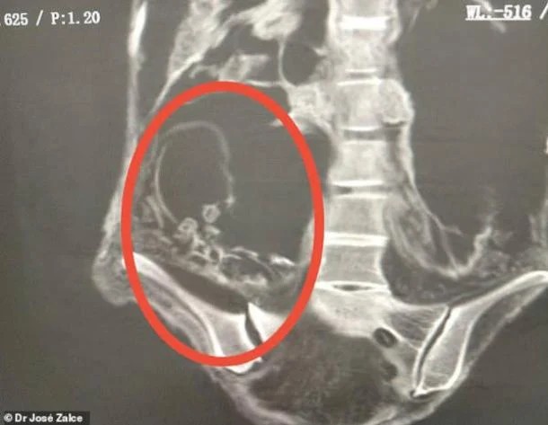 Immagine scansionata che mostra un presunto feto all'interno di una presunta mummia "aliena" dal Perù. (Dr. José Zalce).
