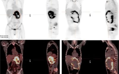 RRx-001-induced tumor necrosis and immune cell Infiltration in an EGFR mutation-positive NSCLC with resistance to EGFR tyrosine kinase inhibitors: A case report
