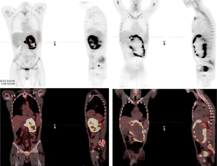 RRx-001-Induced Tumor Necrosis and Immune Cell Infiltration in an EGFR Mutation-Positive NSCLC with Resistance to EGFR Tyrosine Kinase Inhibitors: A Case Report.