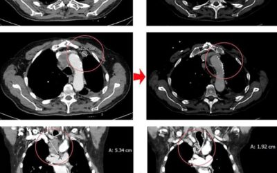 Partial Response in an RRx-001-Primed Patient with Refractory Small-Cell Lung Cancer after a Third Introduction of Platinum Doublets.