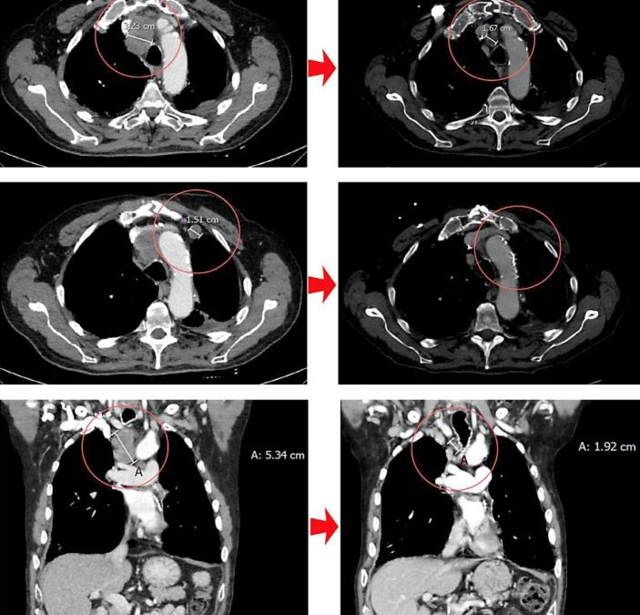 Partial Response in an RRx-001-Primed Patient with Refractory Small-Cell Lung Cancer after a Third Introduction of Platinum Doublets.