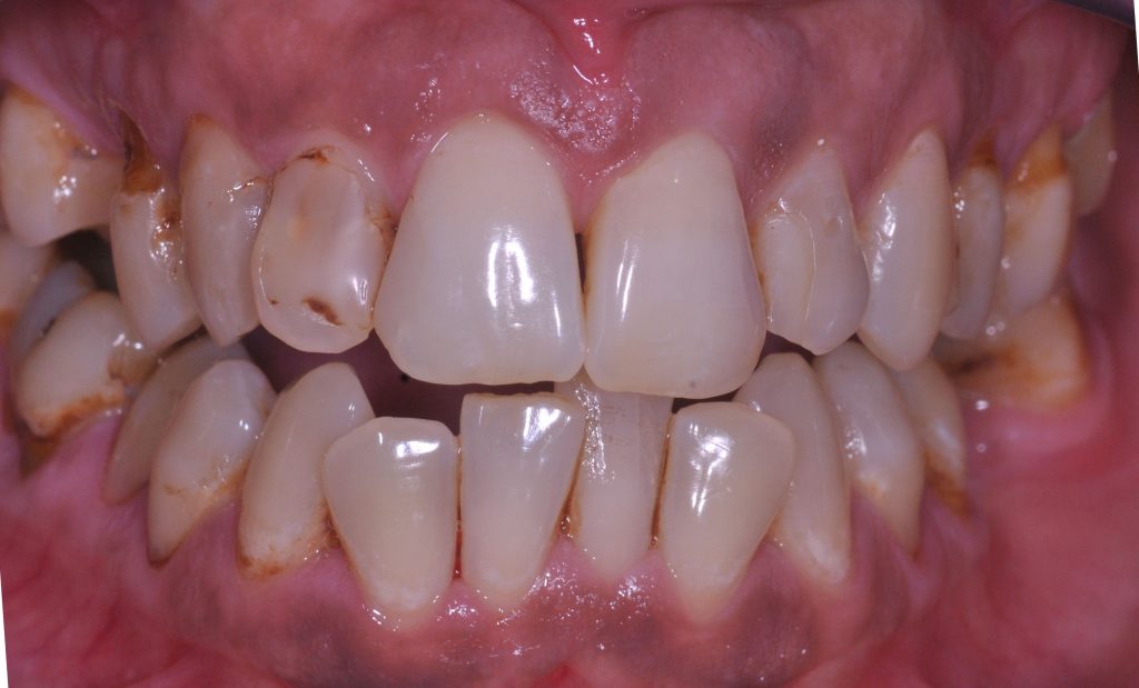 foto's Composiet Facings: - Esthetische Tandheelkunde