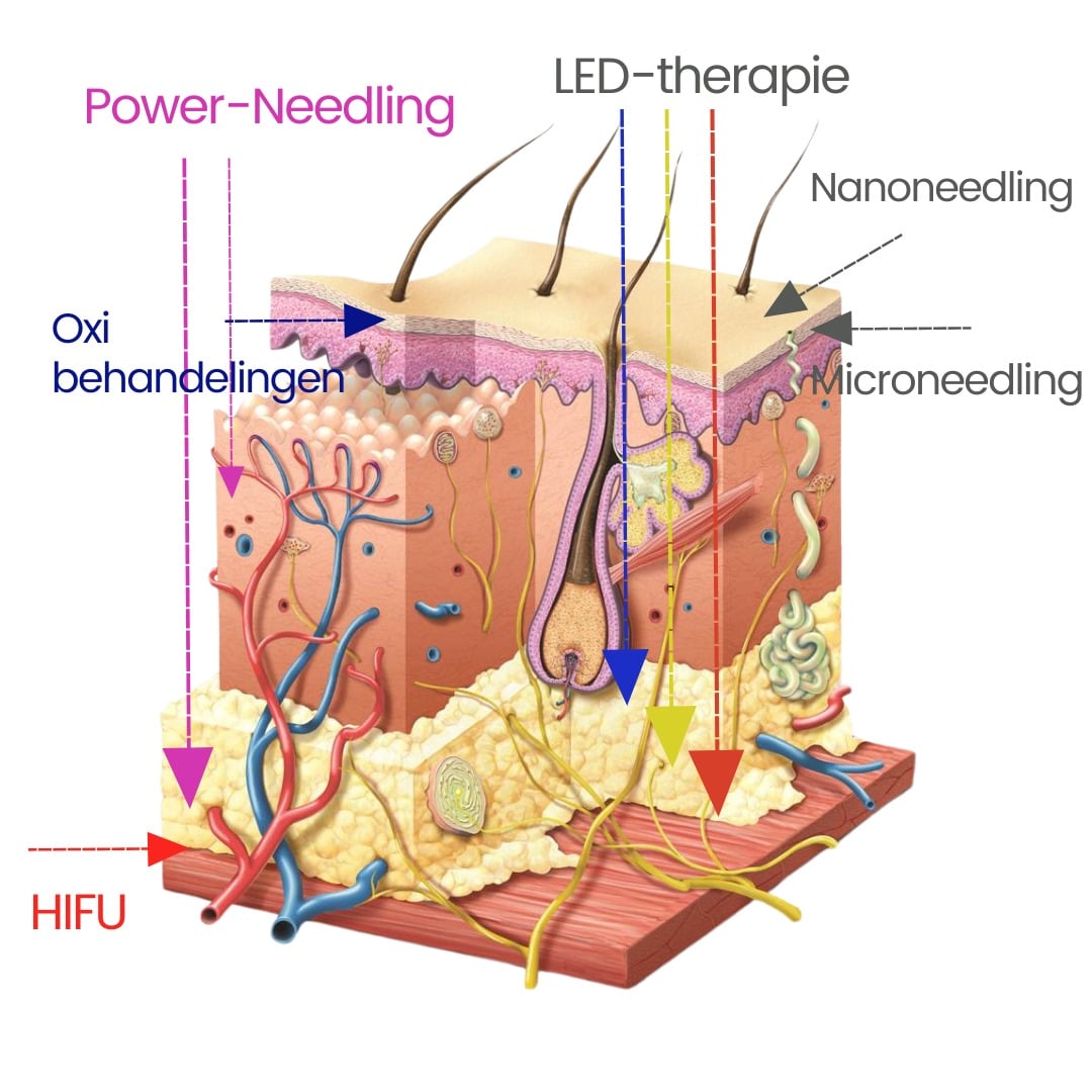 HIFU behandeling | Doorsnede Huid