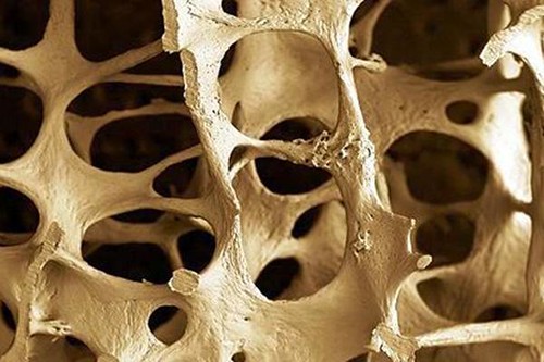Parliamo di Osteoporosi