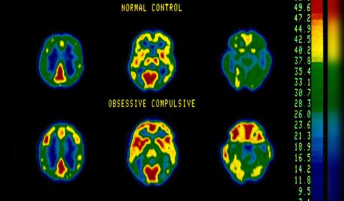 Understanding OCD: A Neuroimaging Perspective