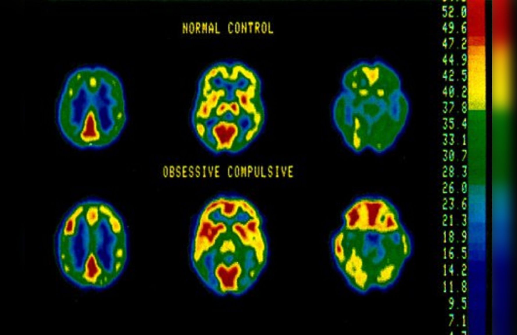 Understanding OCD: A Neuroimaging Perspective