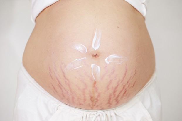 stretch marks in pregnancy