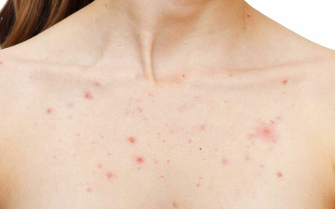 acne on a woman's chest
