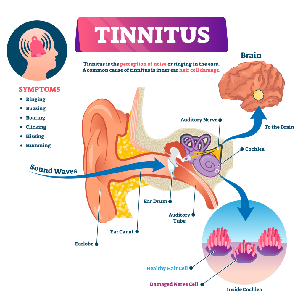 what is tinnitus