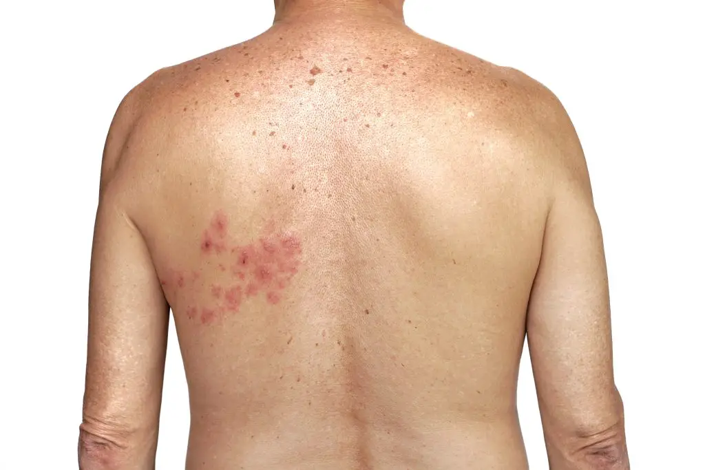Gürtelrose am Rücken - Herpes Zoster