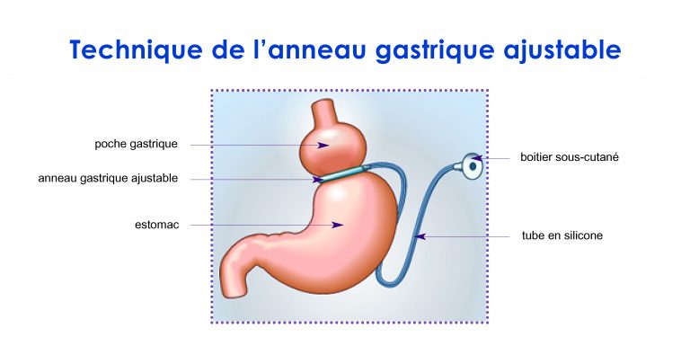 Le Parcours Bariatrique Ucgdb