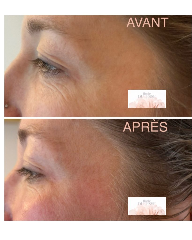 Massage Kobido – Soin liftant et ancrage émotionnel