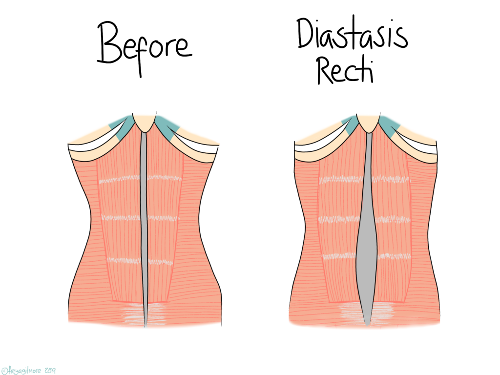 Diastasis recti