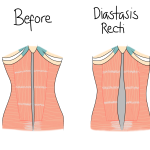 Diastasis recti