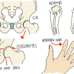 Osteoarthritis: the most common arthritis explained