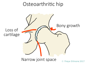 Osteoarthritis in the hip