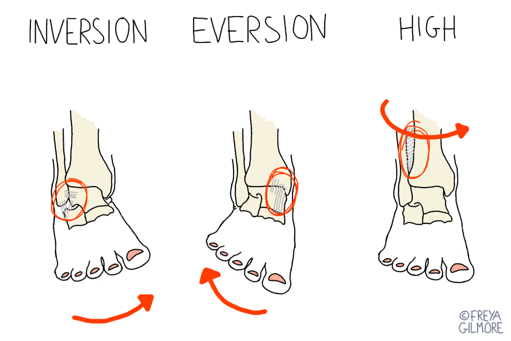 Ankle sprains