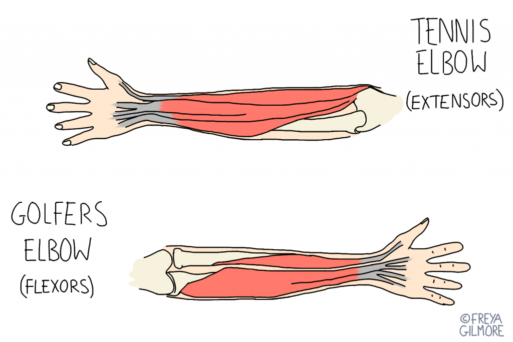 Tennis Elbow & Golfers Elbow