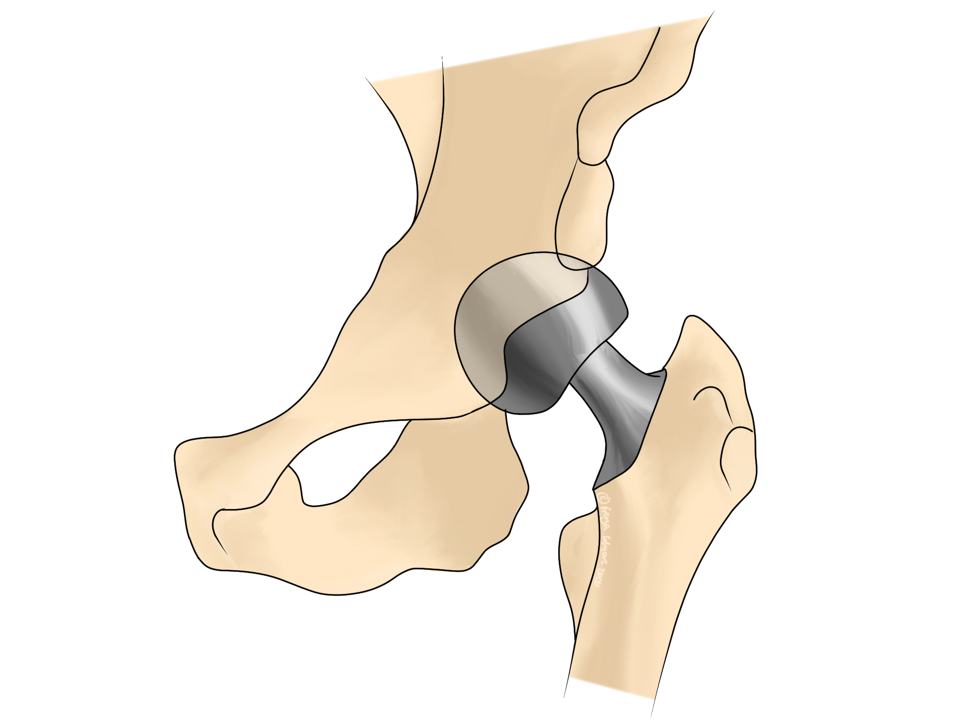 Hip_Replacement_