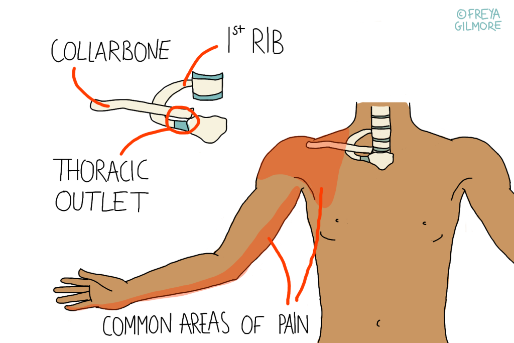 Thoracic outlet syndrome: TOS