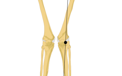Hips that affect the knees
