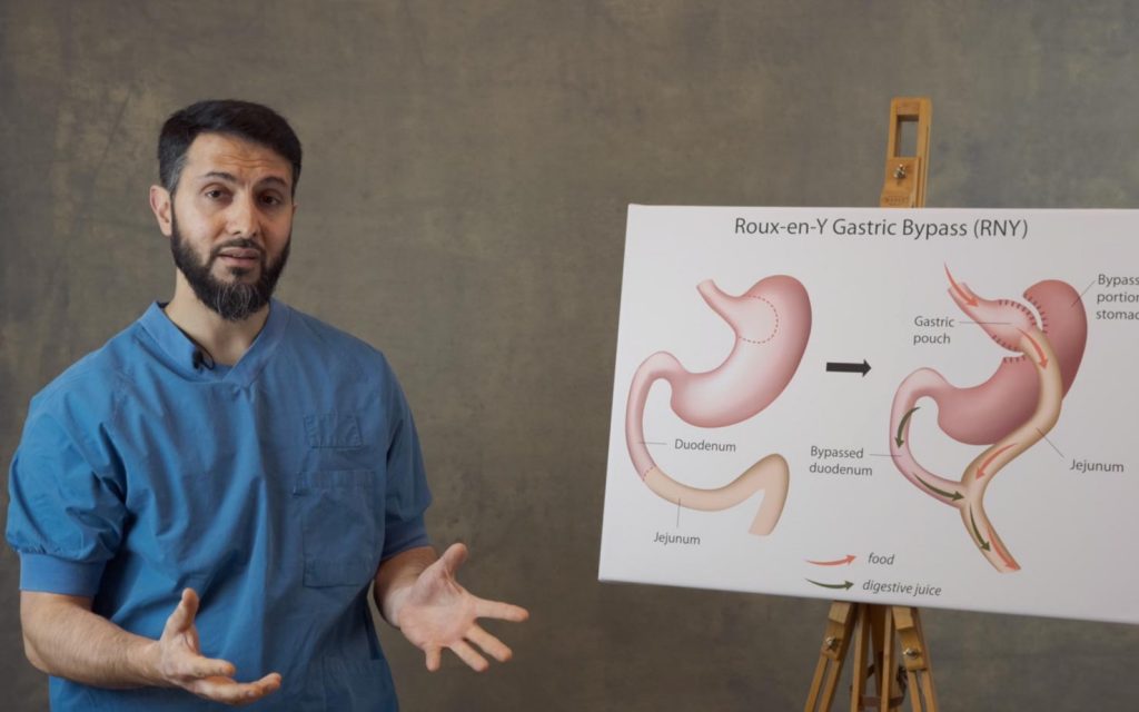 gastric bypass fedmeoperation