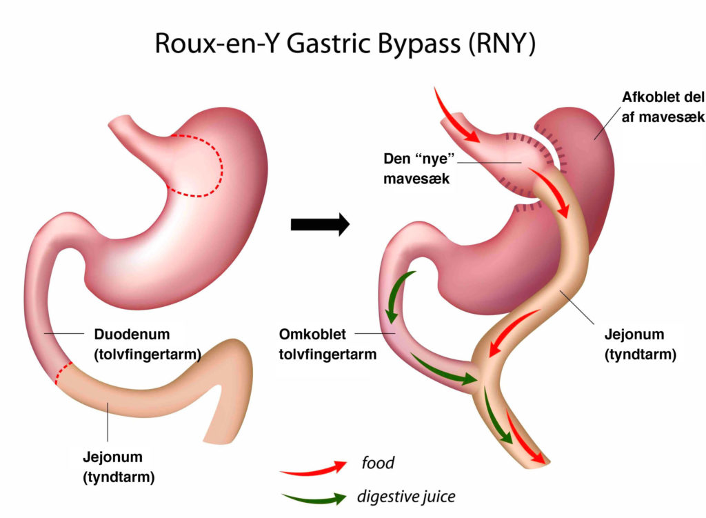 Roux-en-Y Gastric-bypass