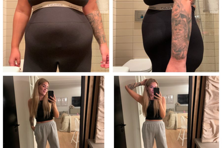 Gastric sleeve Ditte