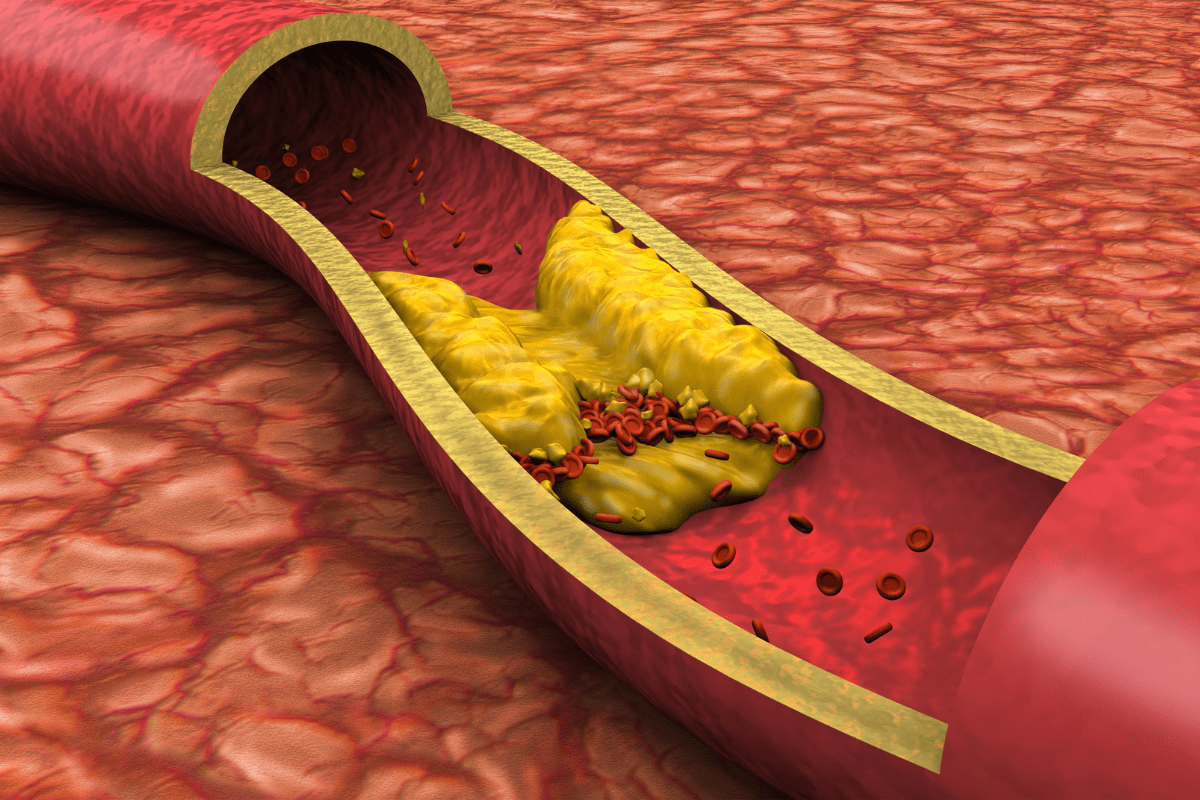 Die Arterien Reinigen: 8 Effektive Lebensmittel