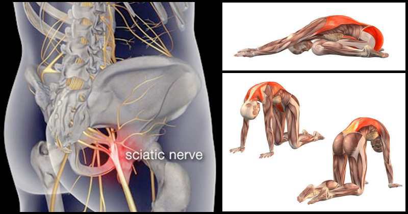 5 Exercises to Avoid If You Have Sciatica