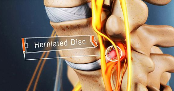 What You Need to Know About Exercising with a Herniated Disc