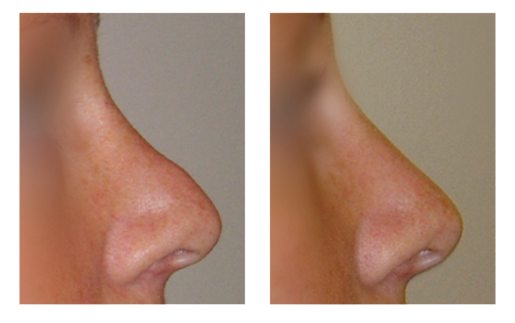 næsekirurgi før og efter billede
