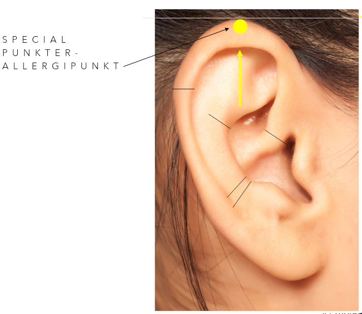 øreakupunktur - allergipunkt
