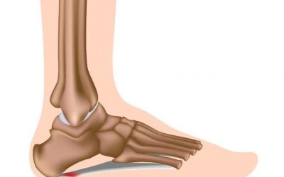 Plantar fasciitis