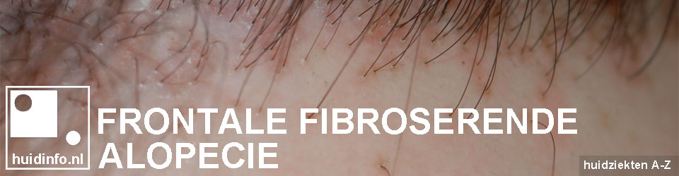 frontale fibroserende alopecie haaruitval verliitekening