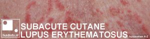 subacute cutane lupus erythematosus
