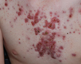 ernstige acne