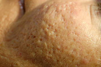 acnelittekens acne litteken icepick ijspriem