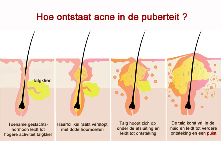 Conflict Defilé Ladder ACNE (JEUGDPUISTJES) | Wat kan ik doen? | Huidinfo.nl