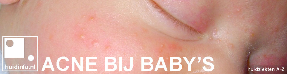 acne bij baby's