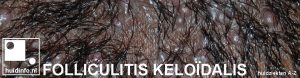 folliculitis keloidalis acne litteken behaarde hoofd
